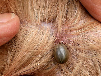 borreliose